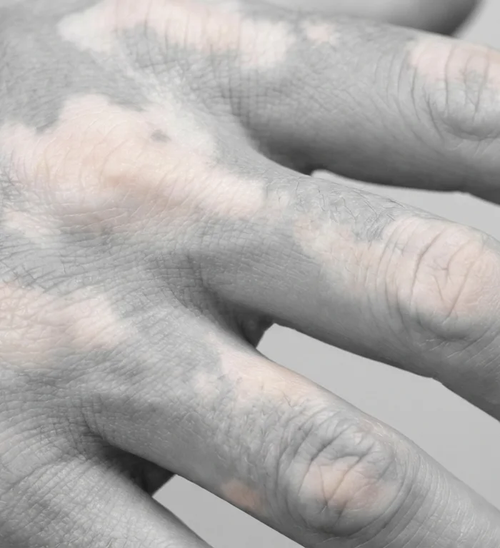 Michael Jackson vitiligo tartışması yeniden gündemde