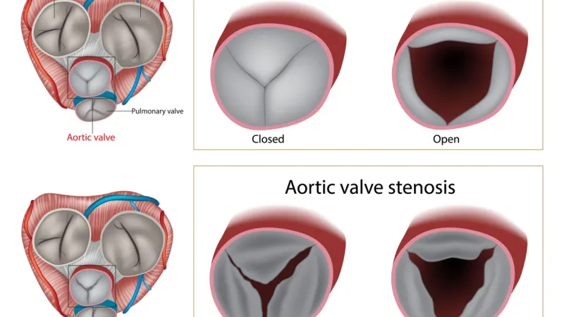 TAVR Yöntemi Kalp Ameliyatlarında Devrim Yaratıyor