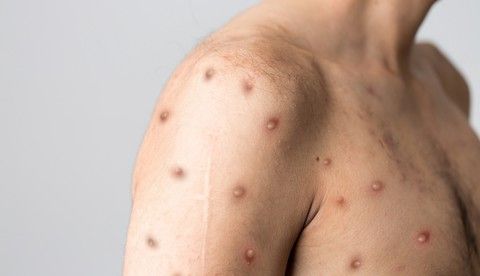 Mpox Variant in SF Sewage Puts Health Officials on Alert