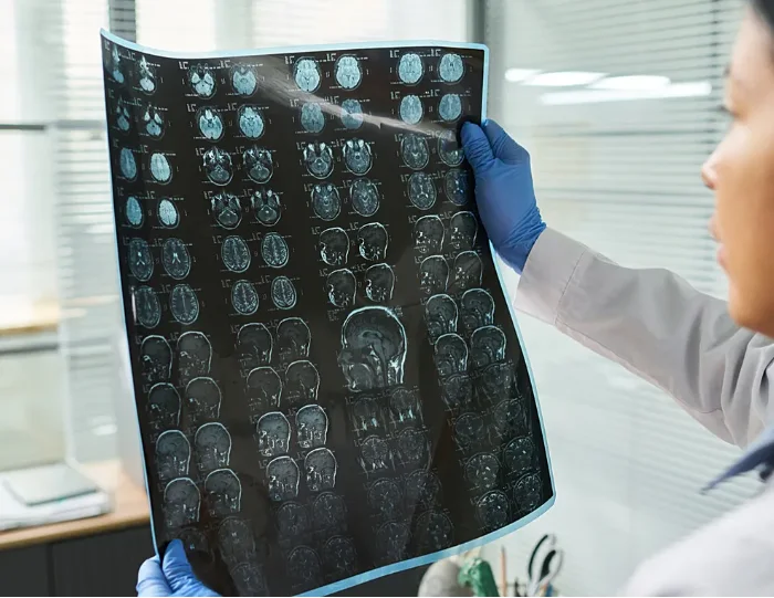 Bilim insanları yapay zeka geliştirildi: DNA'yı analiz ederek inme riskini belirliyor